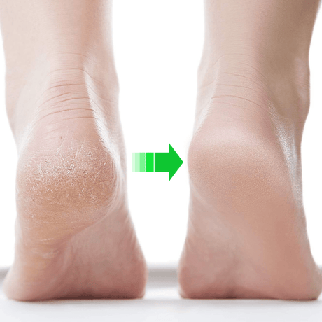 Strumpa mot sprickor i hälen - HeelPad